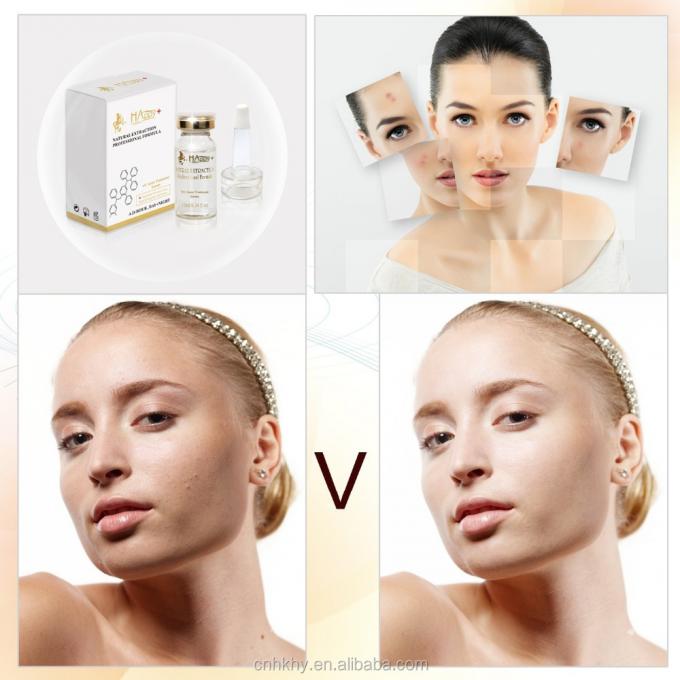 Éliminez les cicatrices d' acné avec QBEKA Happy Cosmetics Levorotatory VC Original Liquid Bio Serum 0